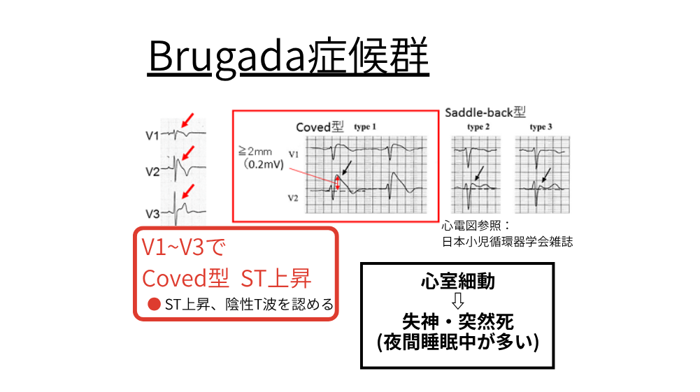 Brugada症候群 心電図解説