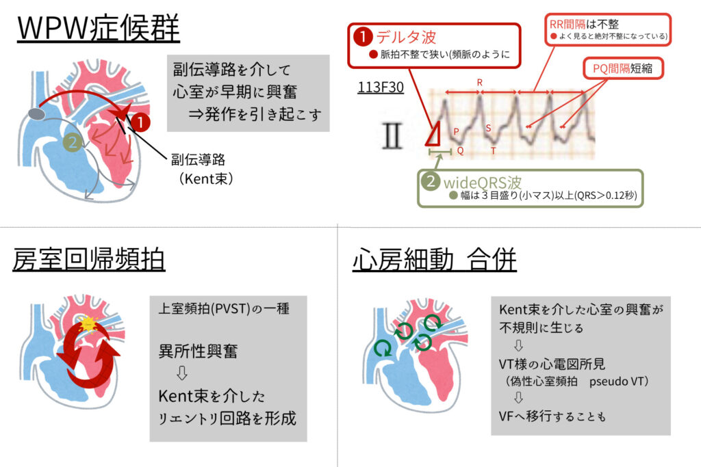 WPW症候群の心電図解説