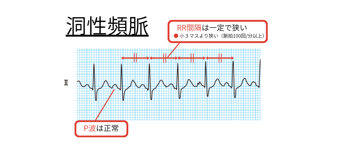 洞性頻脈 心電図解説