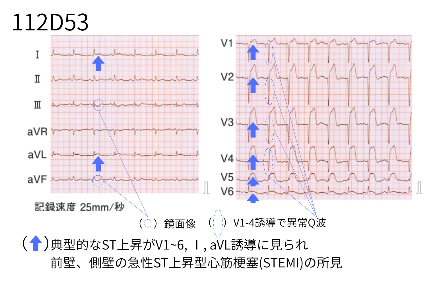 STEMI(ST上昇)心電図例  【112D53】)