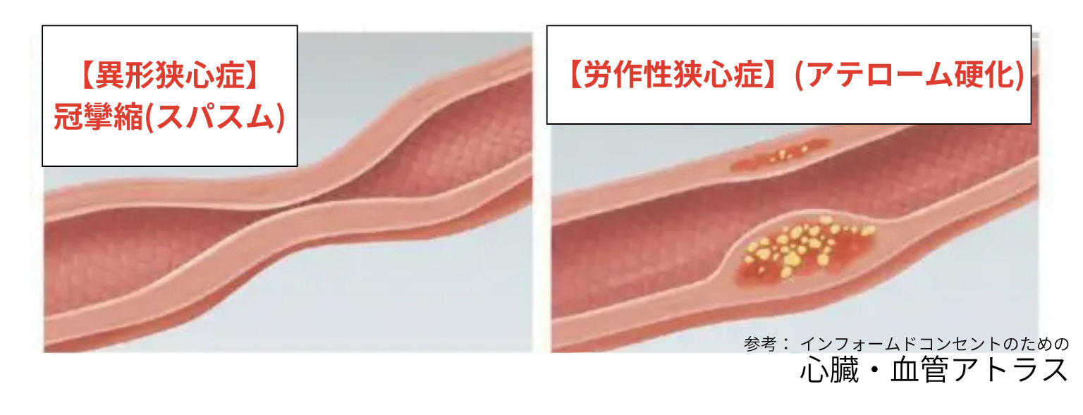 異形狭心症、冠攣縮性狭心症の病態