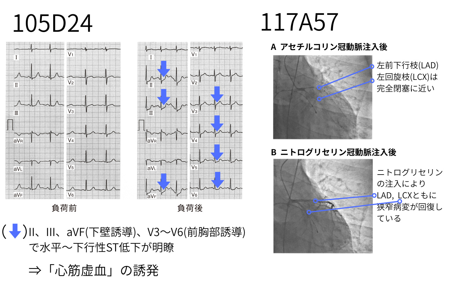 発作時ST変化、冠動脈造影/CTイメージ