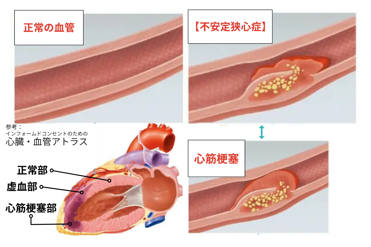 心筋梗塞、不安定狭心症の病態・血管状態)