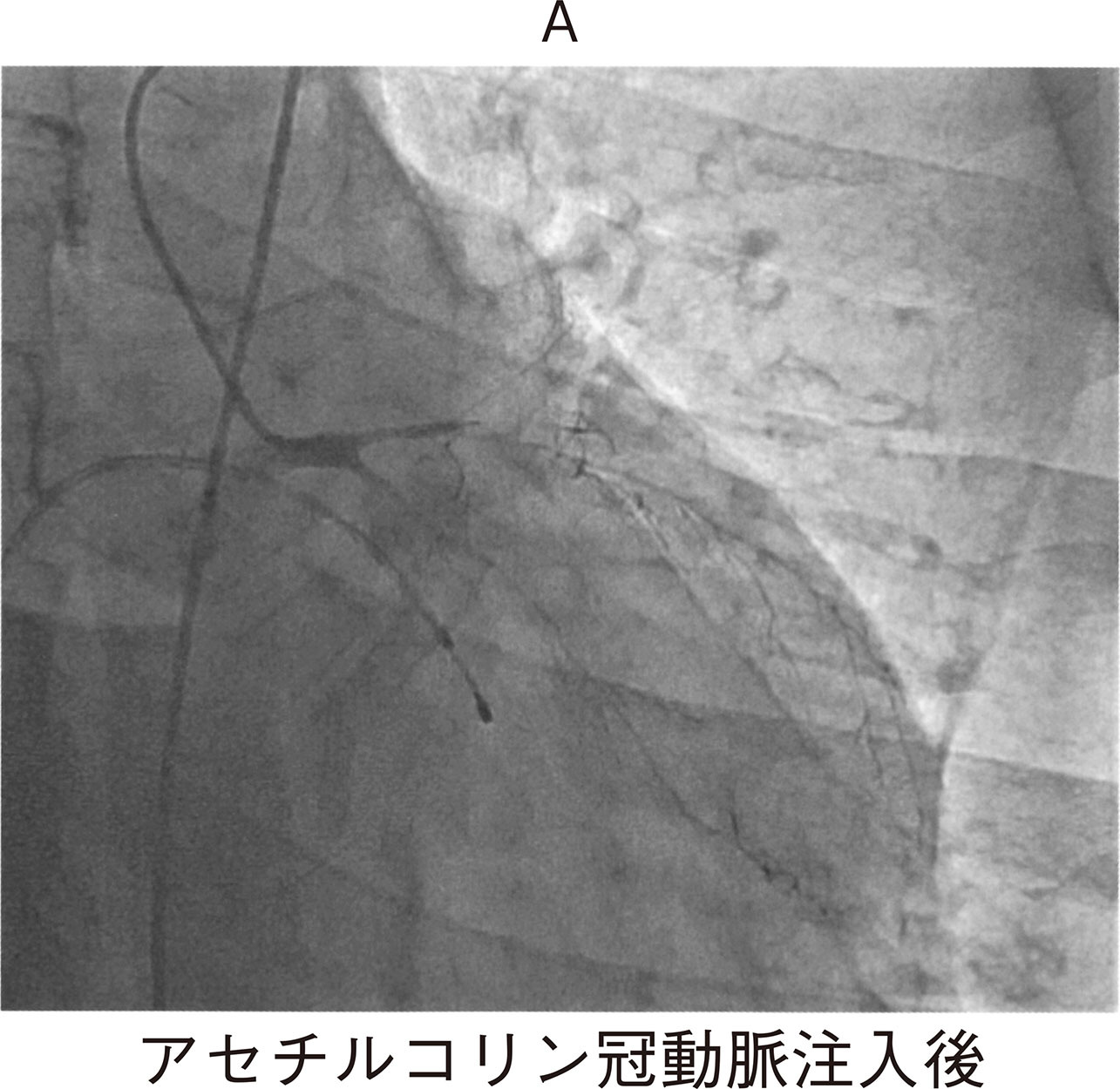 アセチルコリン冠動脈注入後