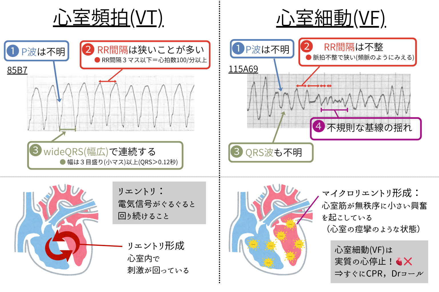 心室頻拍(VT)/心室細動(VF) 説明図