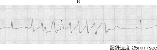 117A71 図B: 発作時心電図モニター波形