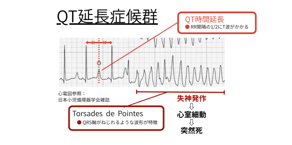 QT延長症候群 心電図解説 / TdP（トルサード・ド・ポアンツ）